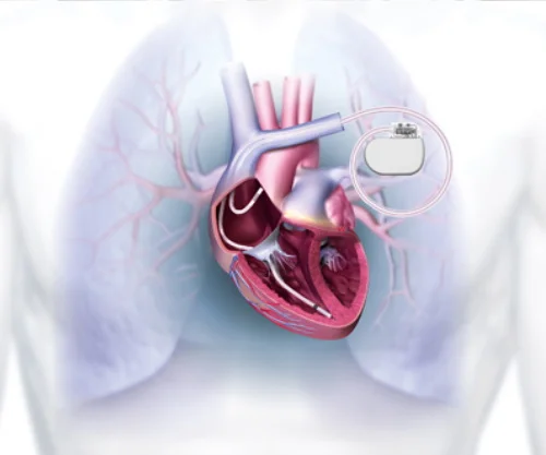 Implantable Cardioverter Defibrillator (ICD/CRTD)